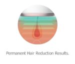 Mini IPL Hair Removal Device - 图片 5